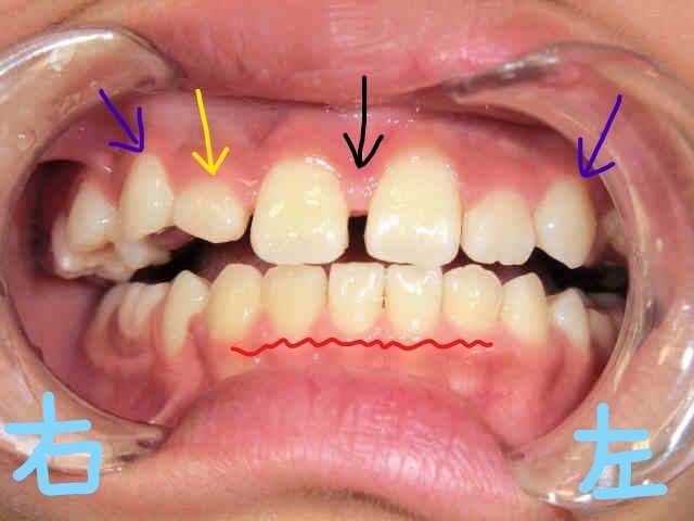 術前レントゲン