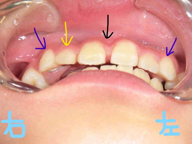 術後レントゲン