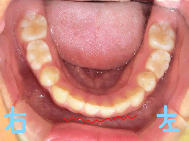 術後レントゲン