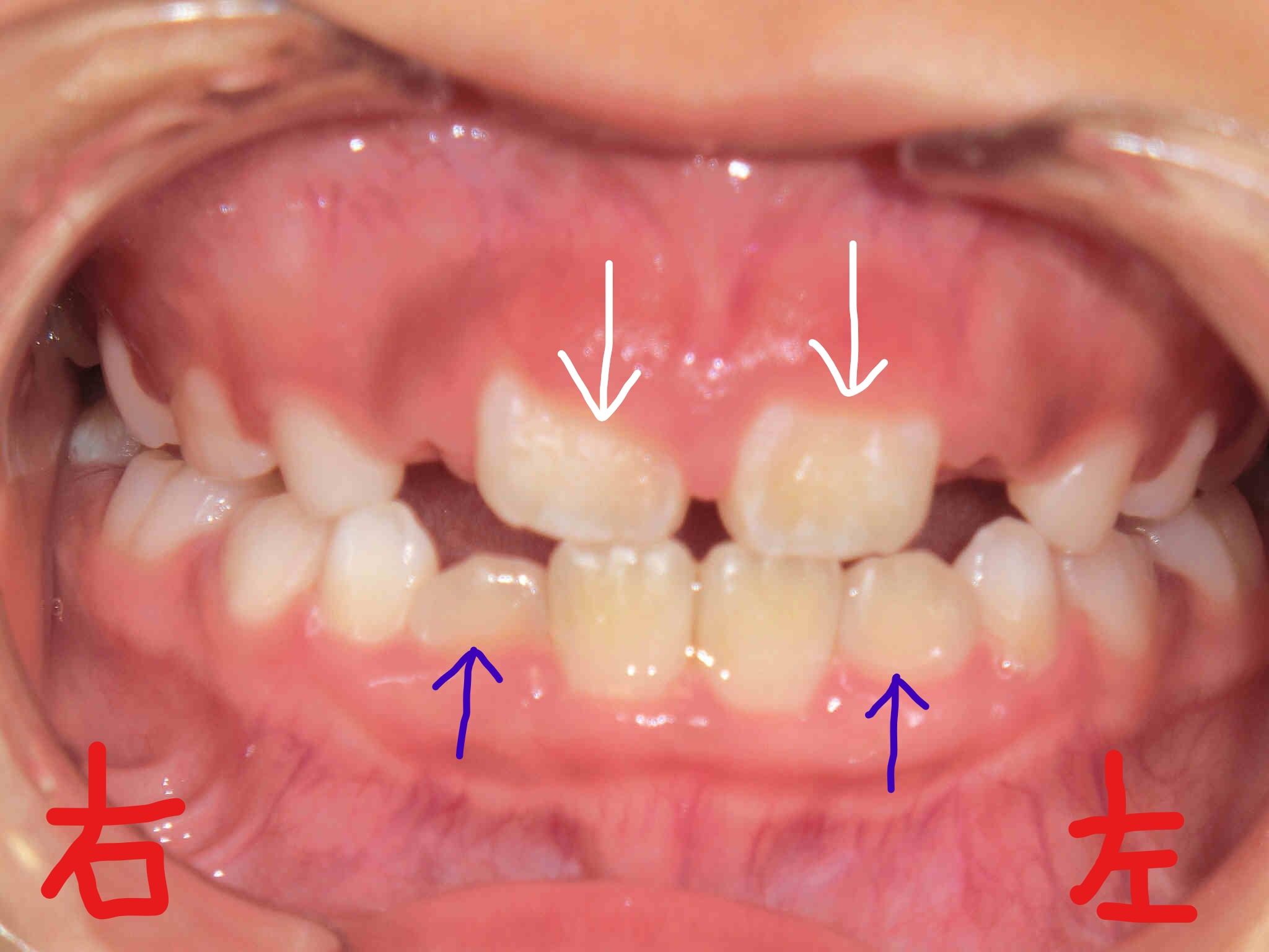 術後レントゲン