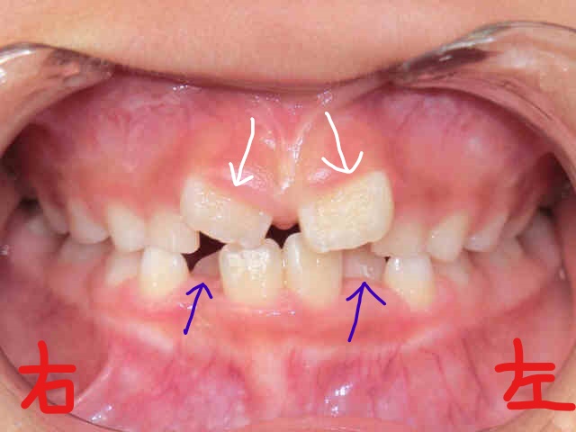 術前レントゲン