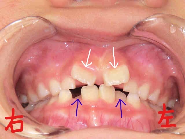 術後レントゲン