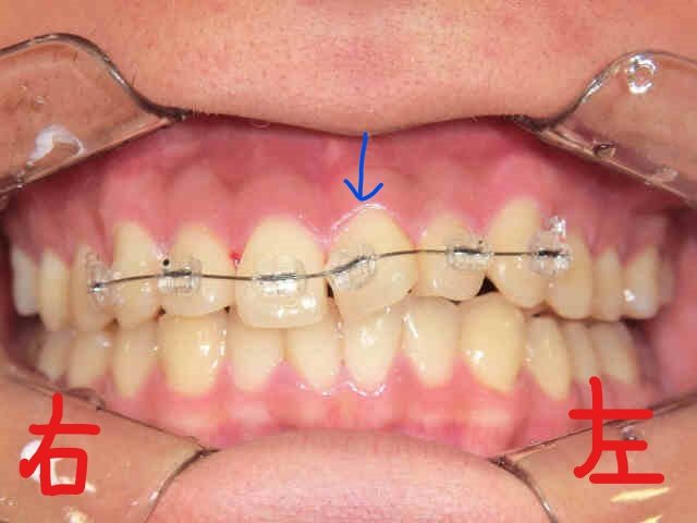 術前レントゲン