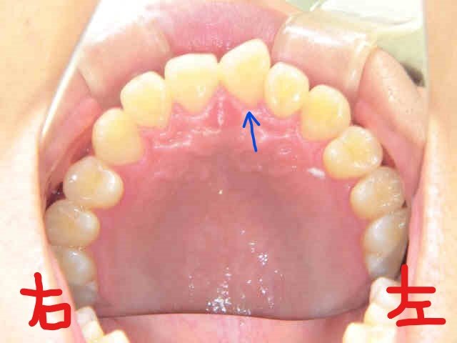 術後レントゲン