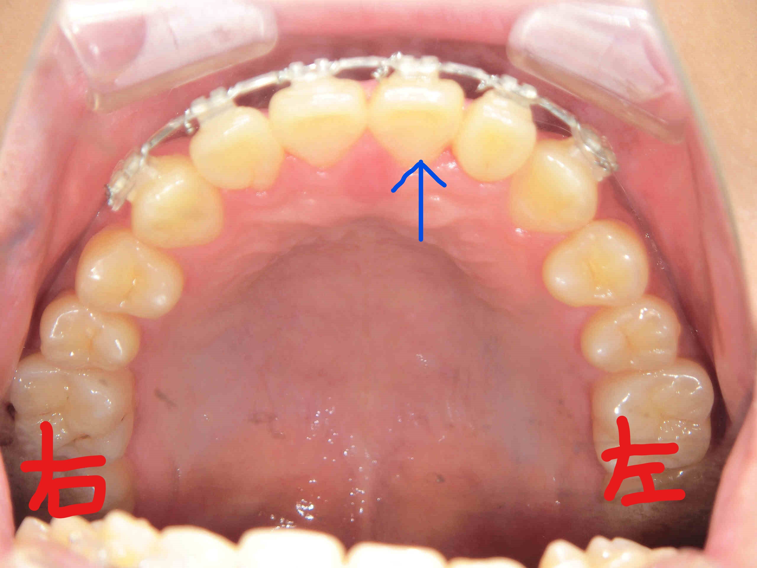 術前レントゲン