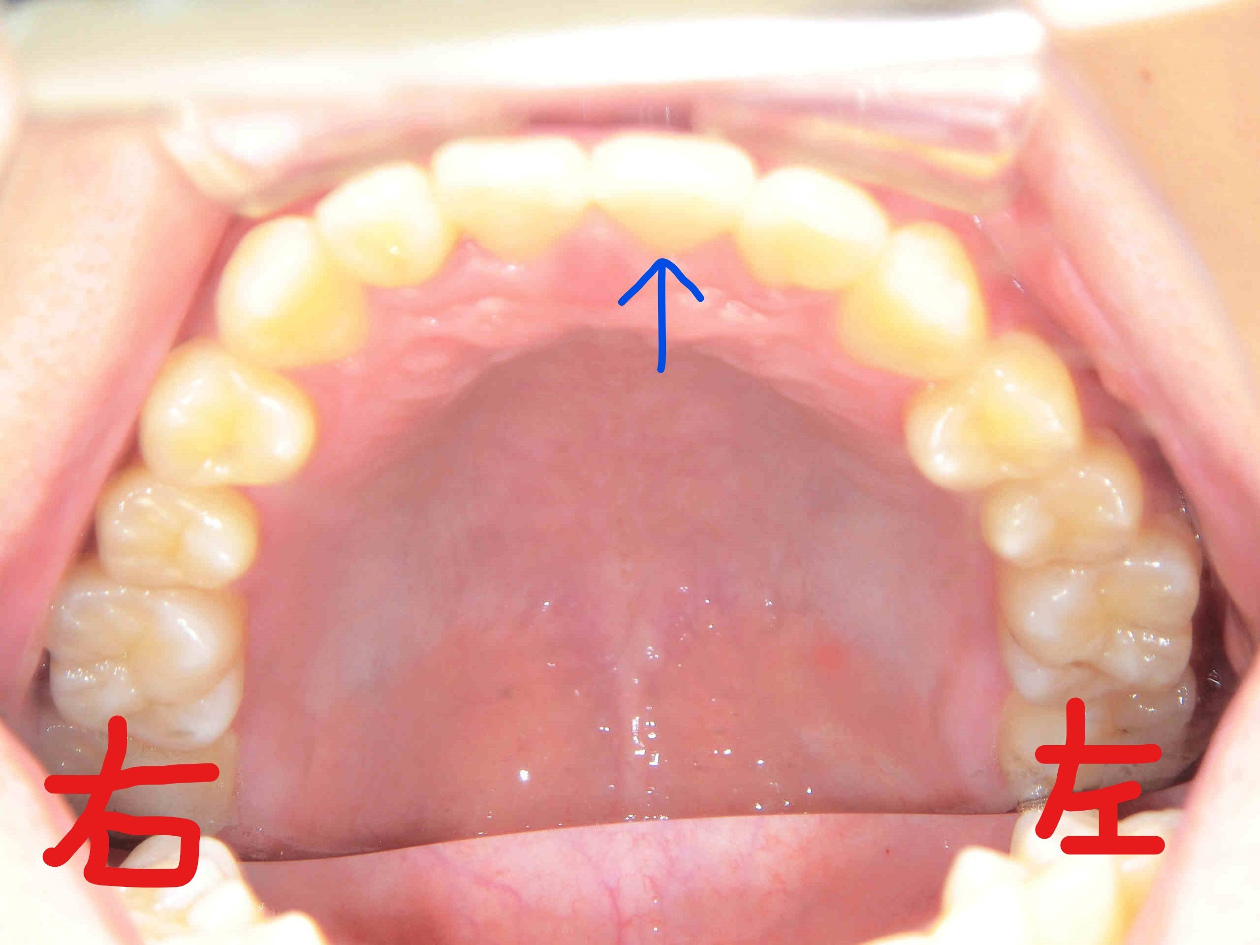 術後レントゲン