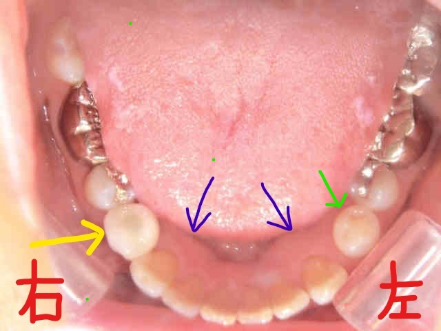 術前レントゲン