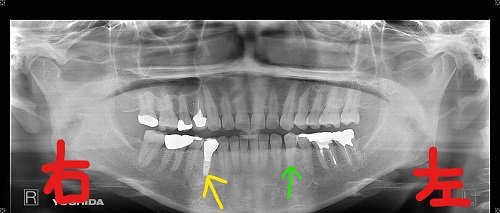 術後レントゲン