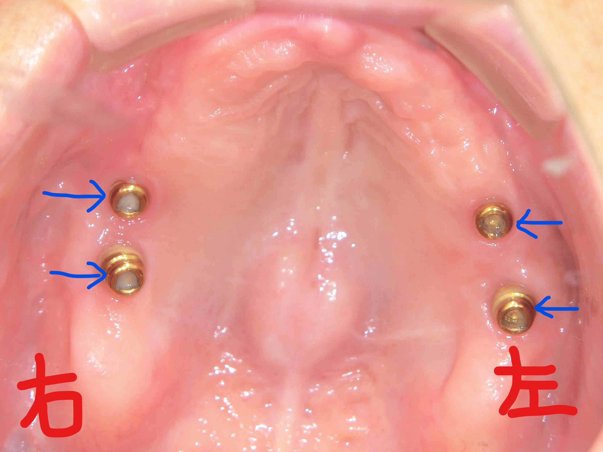術前レントゲン