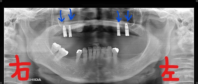 術後レントゲン