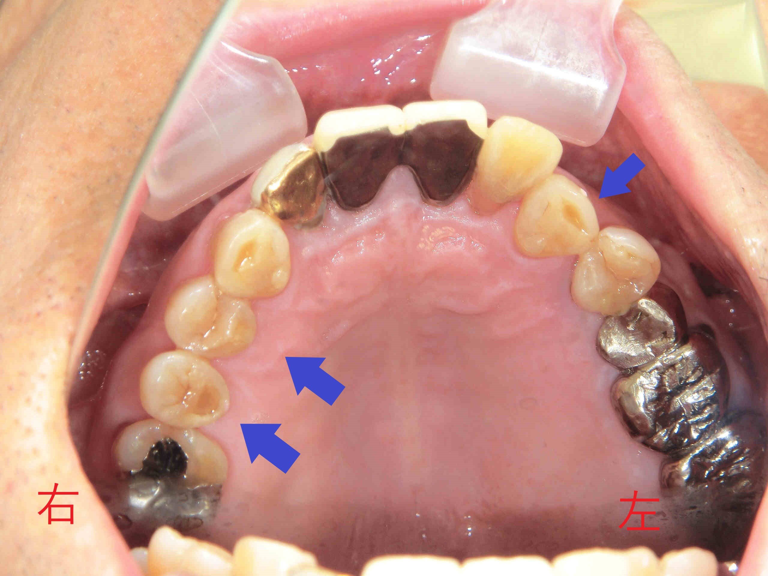 術前レントゲン