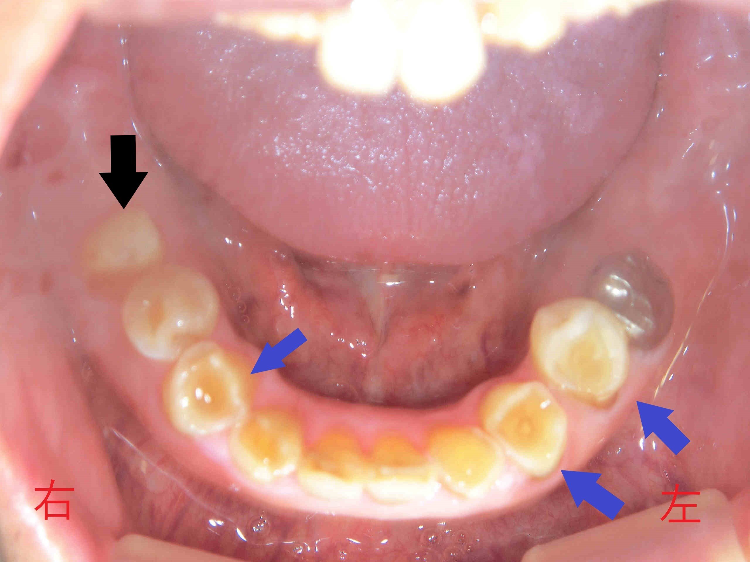 術後レントゲン