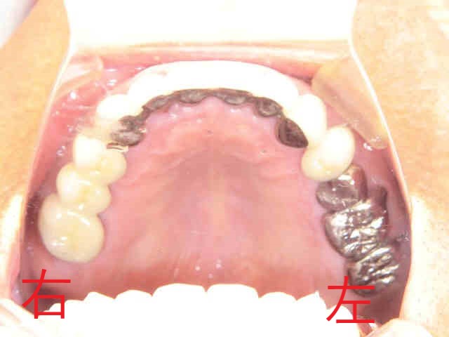 術前レントゲン