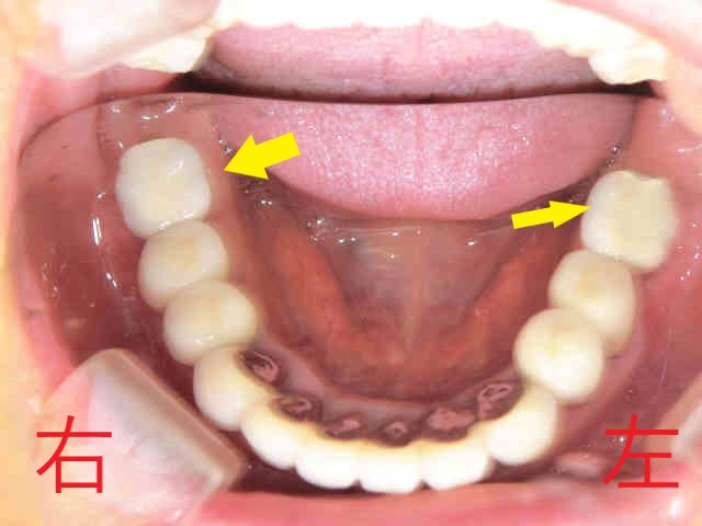 術後レントゲン