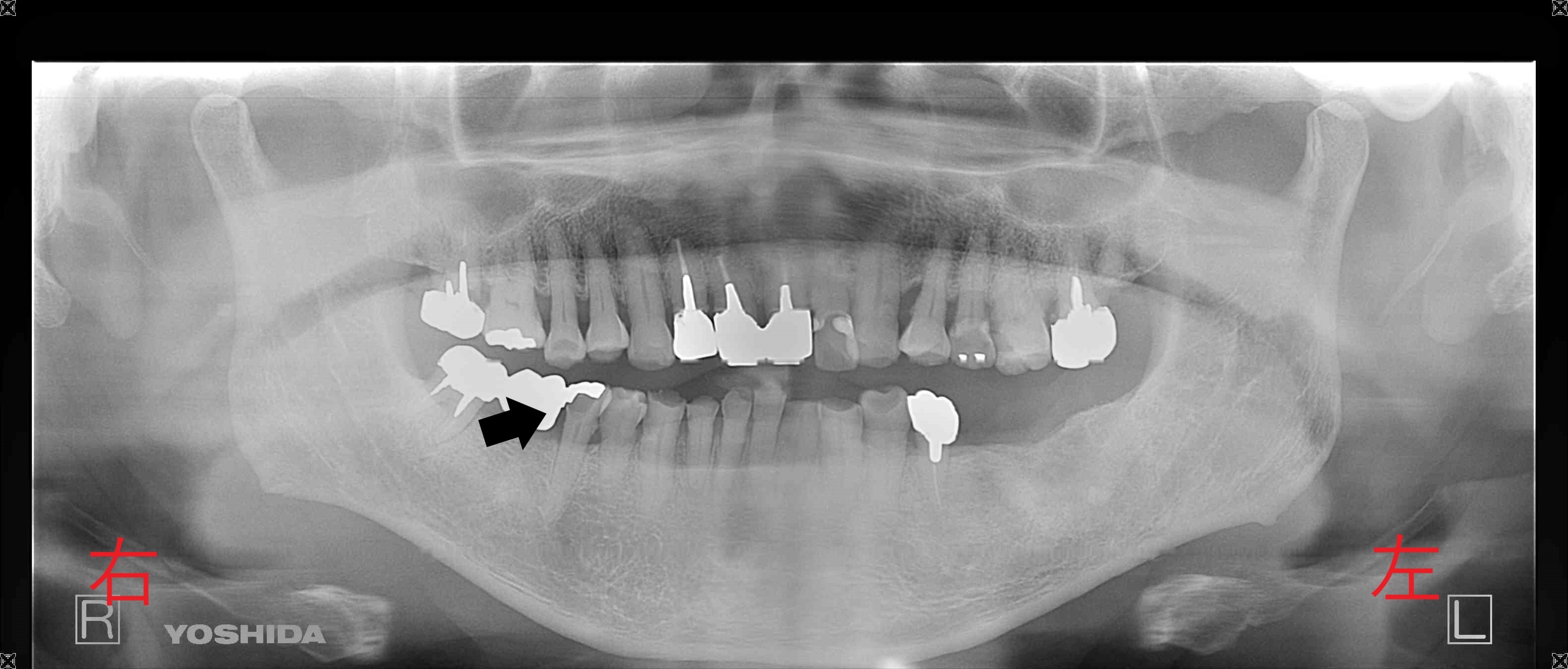 術前レントゲン