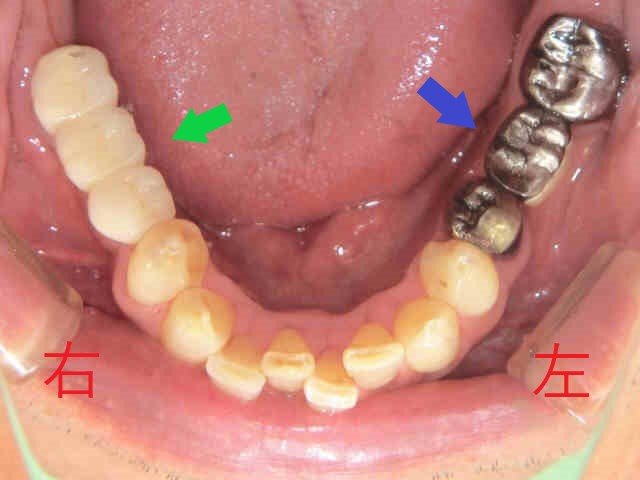 術後レントゲン