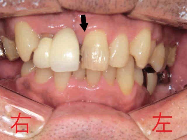 術前レントゲン