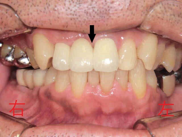 術後レントゲン