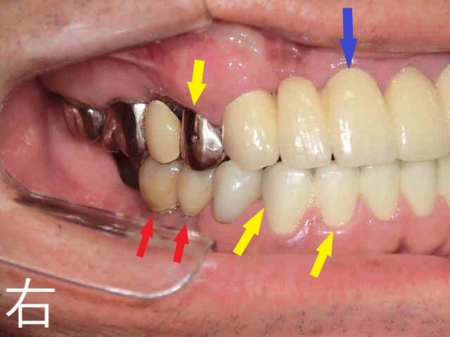 術前レントゲン