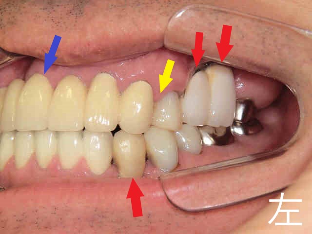 術後レントゲン
