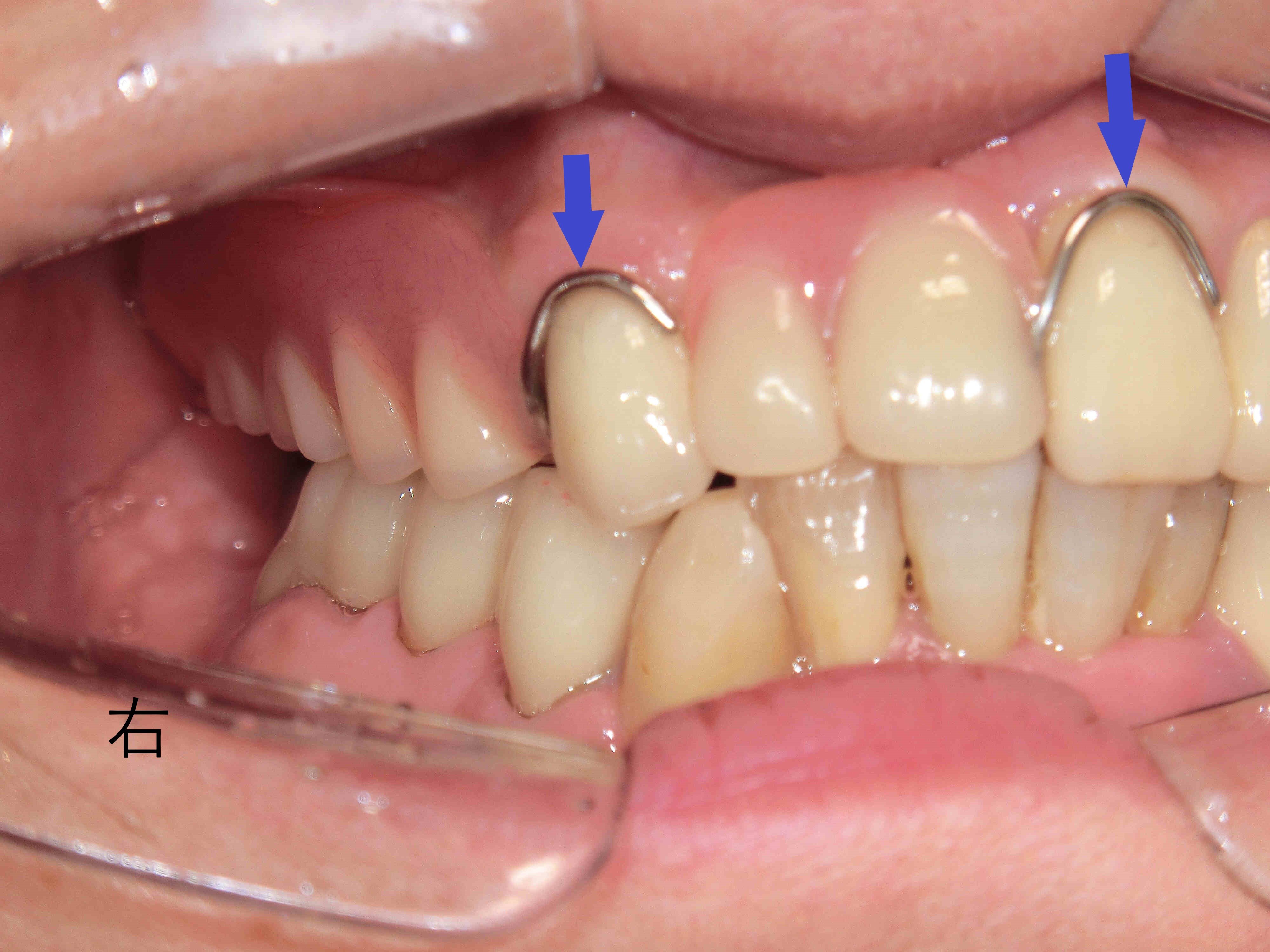 術前レントゲン