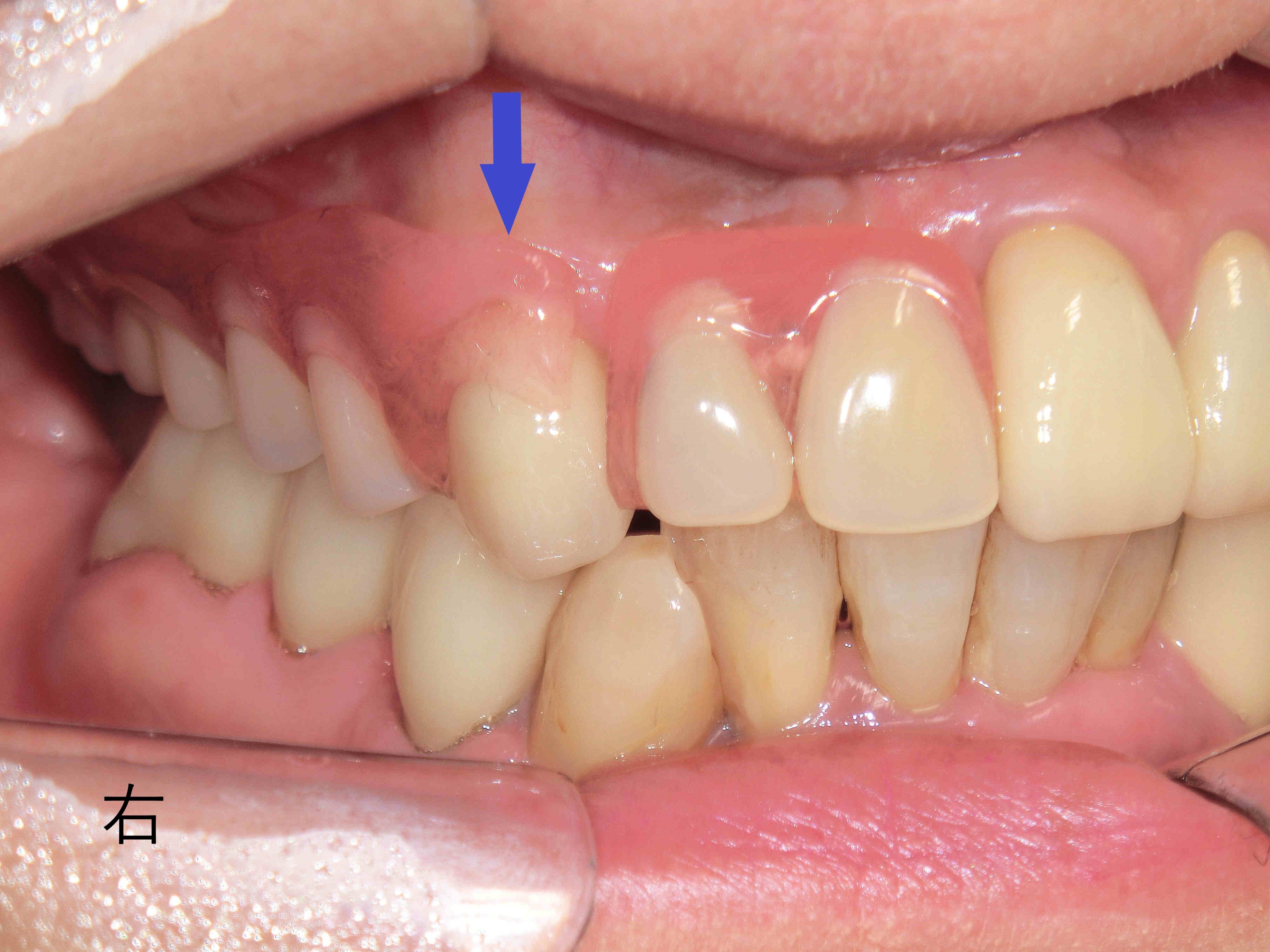 術後レントゲン