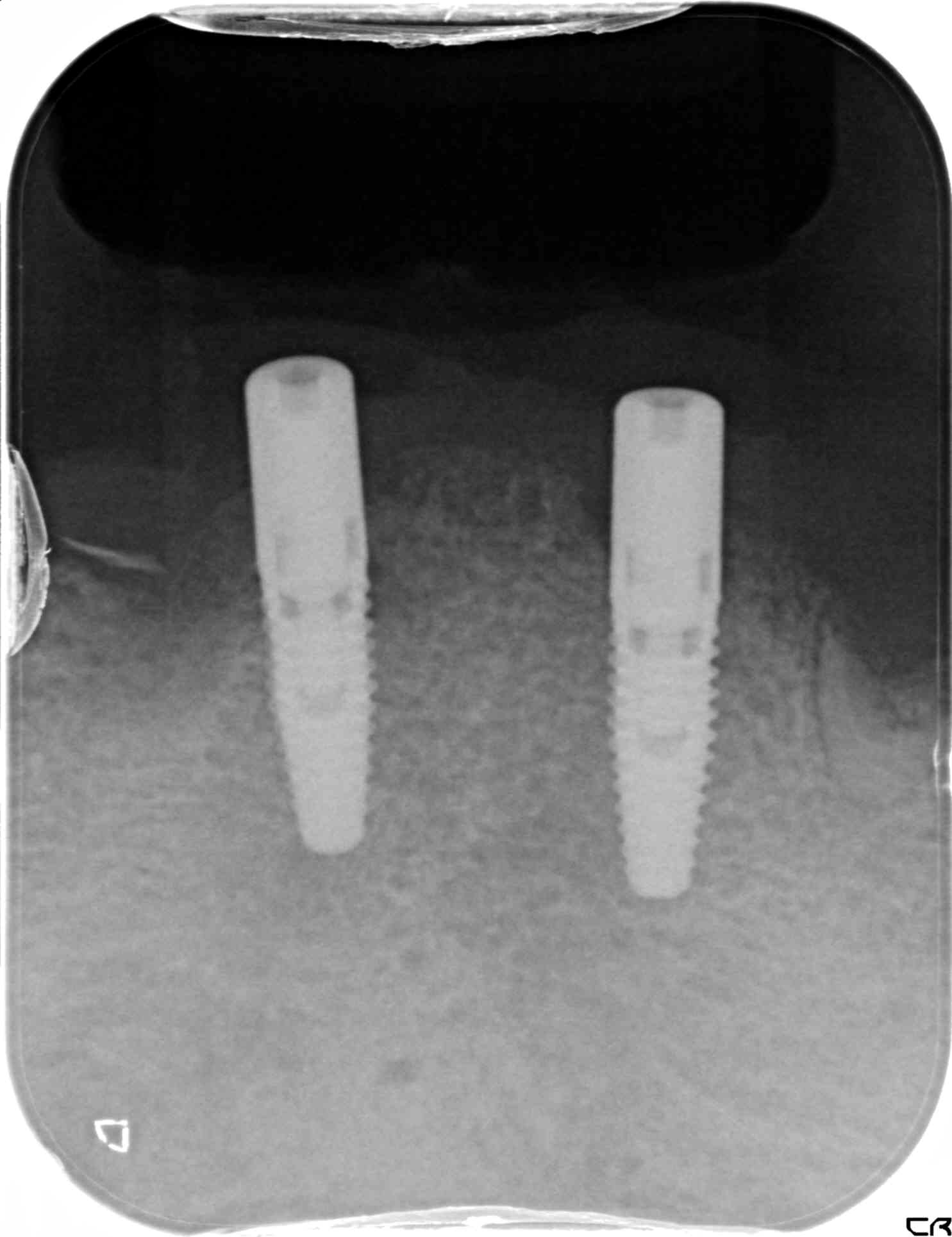 術前レントゲン
