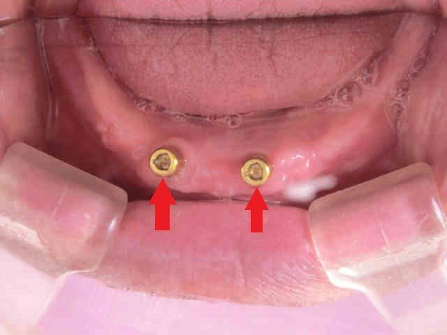 術後レントゲン