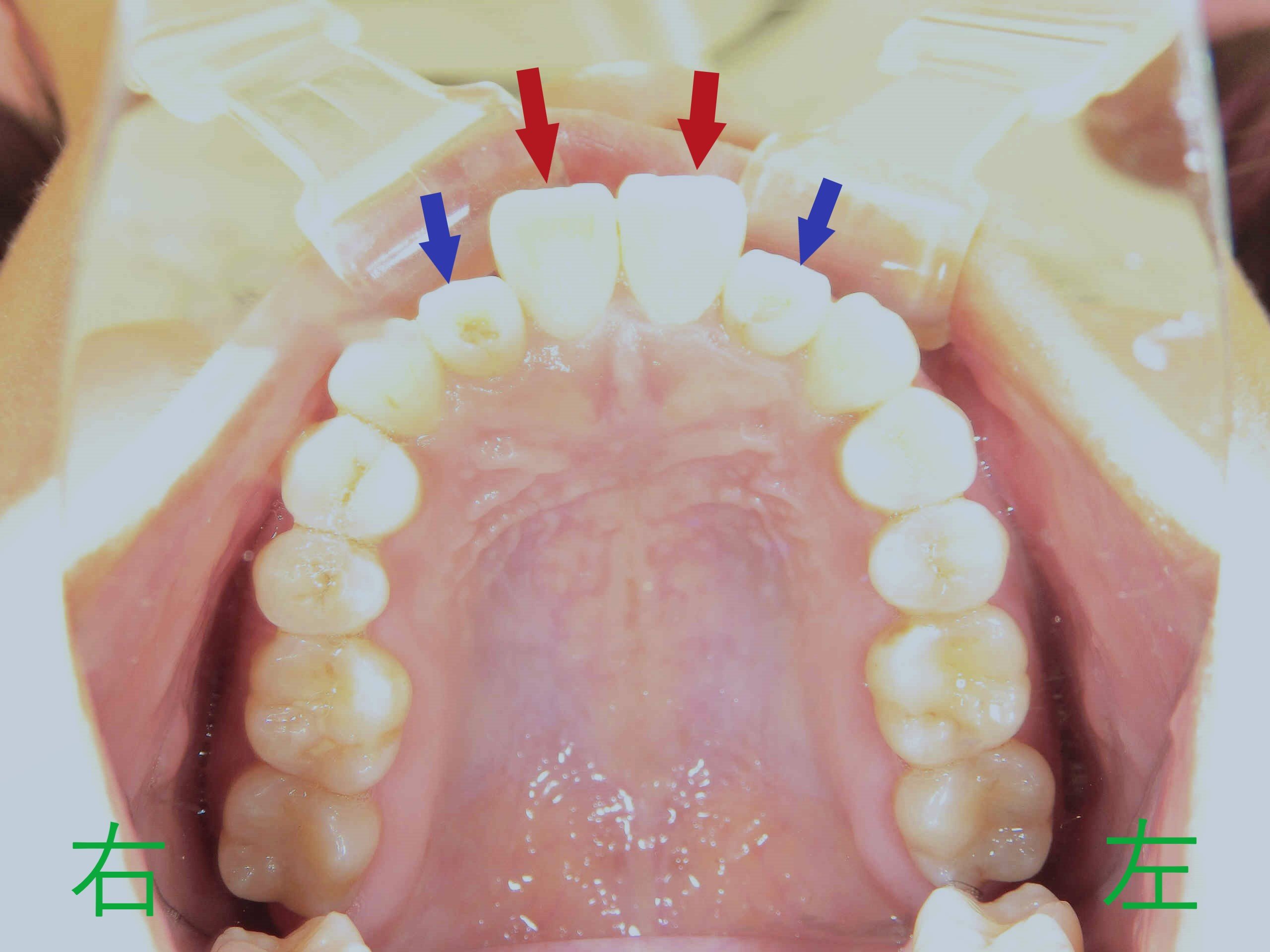 術前レントゲン