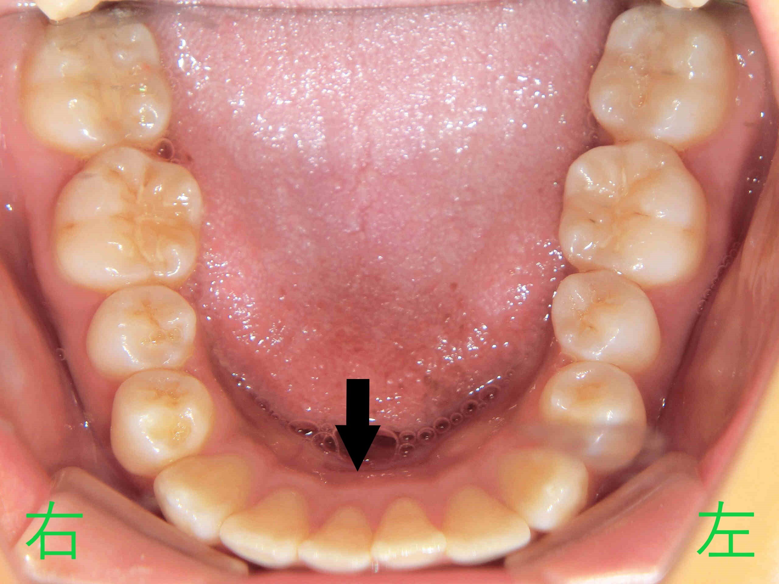 術後レントゲン