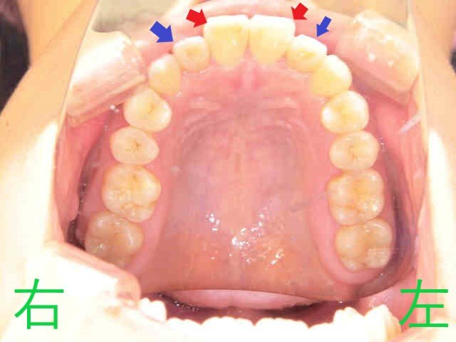 術前レントゲン