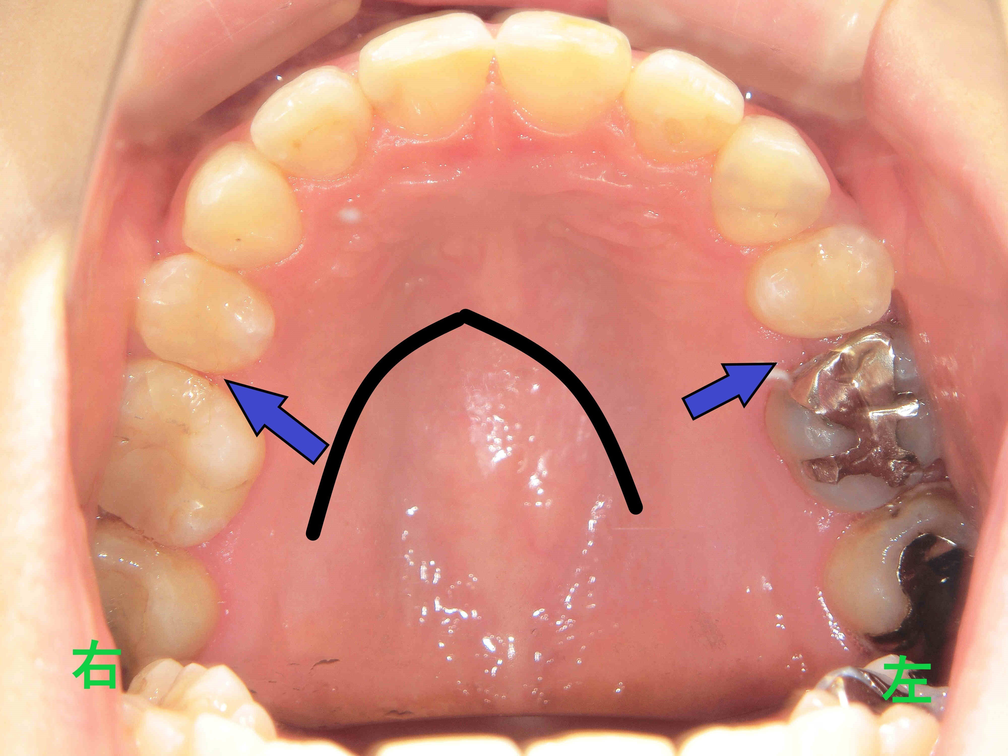 術後レントゲン
