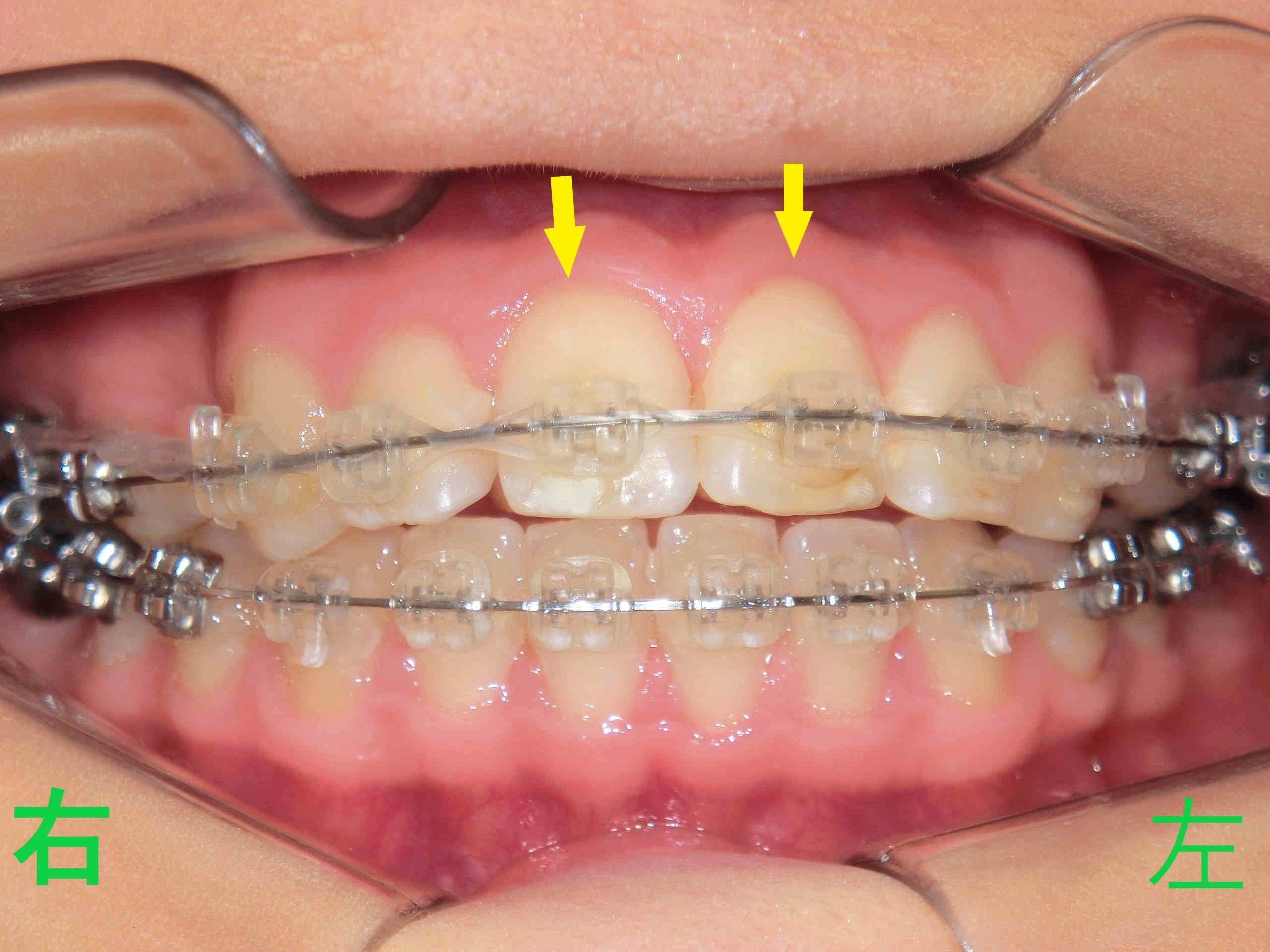 術前レントゲン