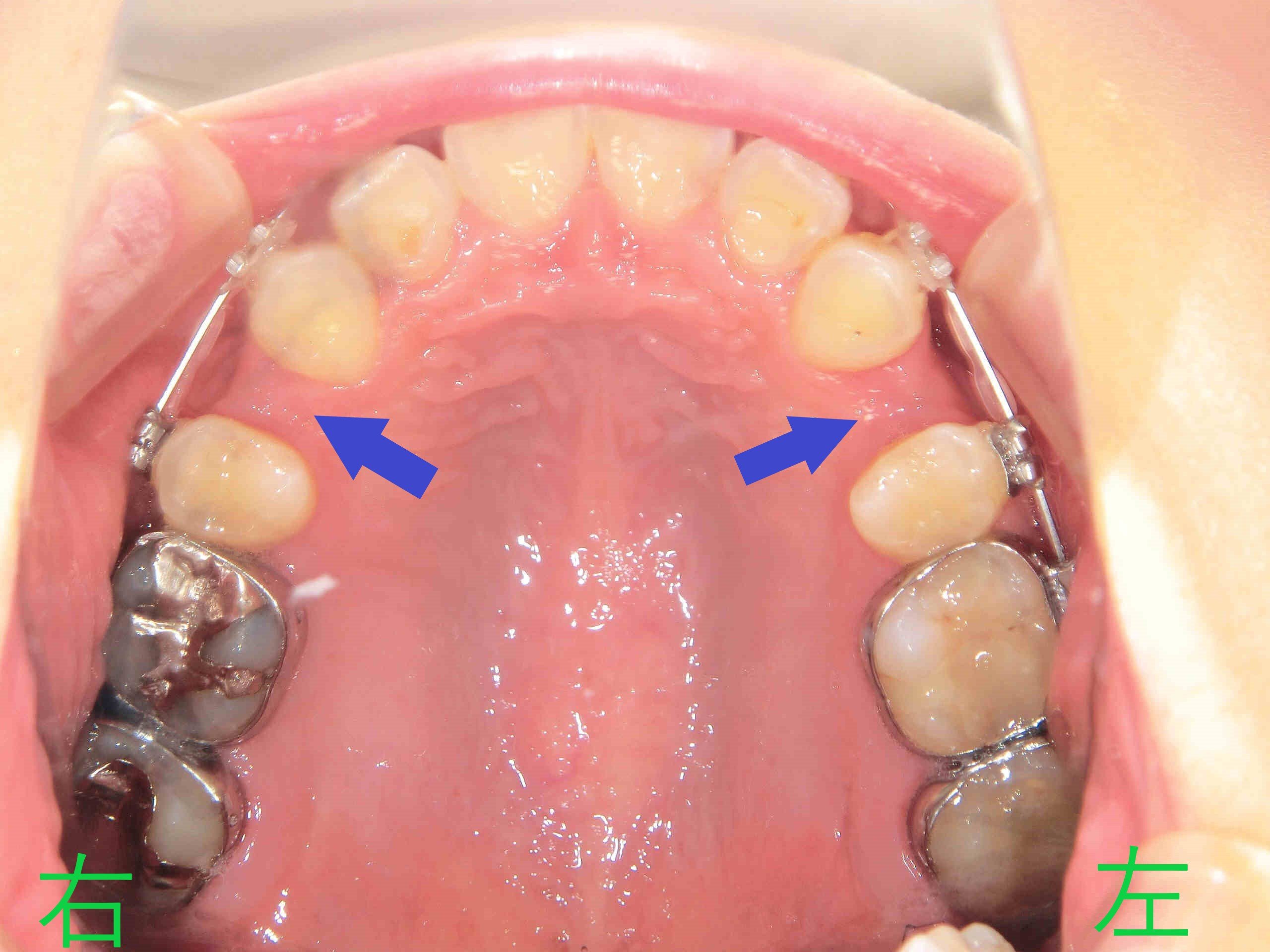 術後レントゲン