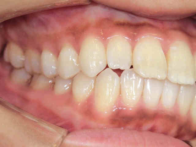 術前レントゲン