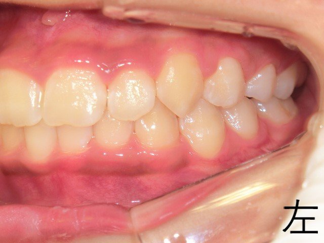 術後レントゲン