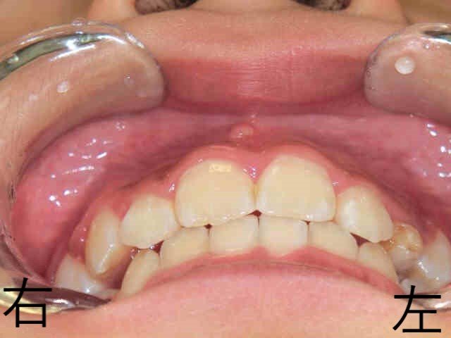 術前レントゲン