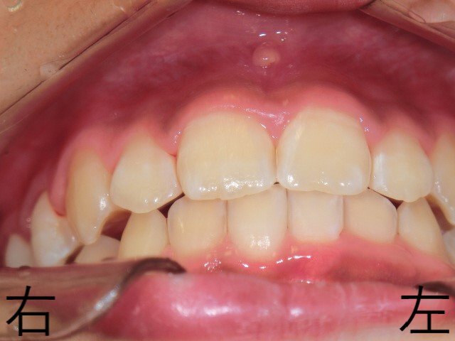 術後レントゲン