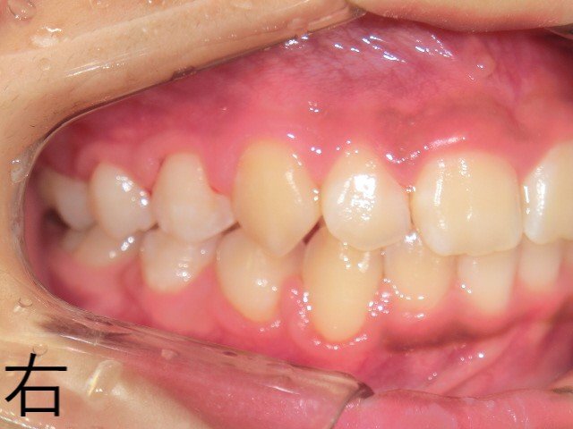 術前レントゲン