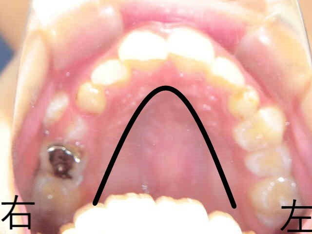 術前レントゲン