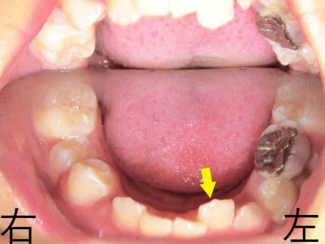 術後レントゲン