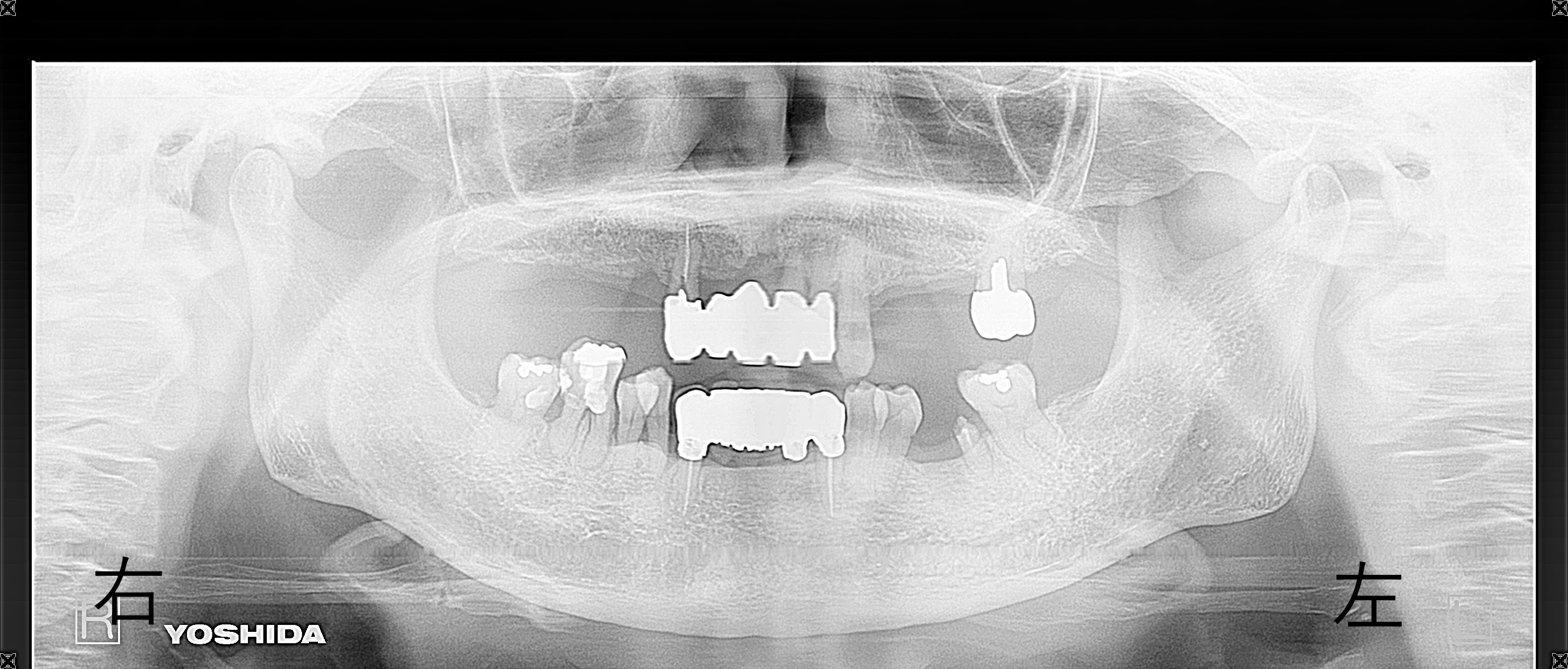 術前レントゲン