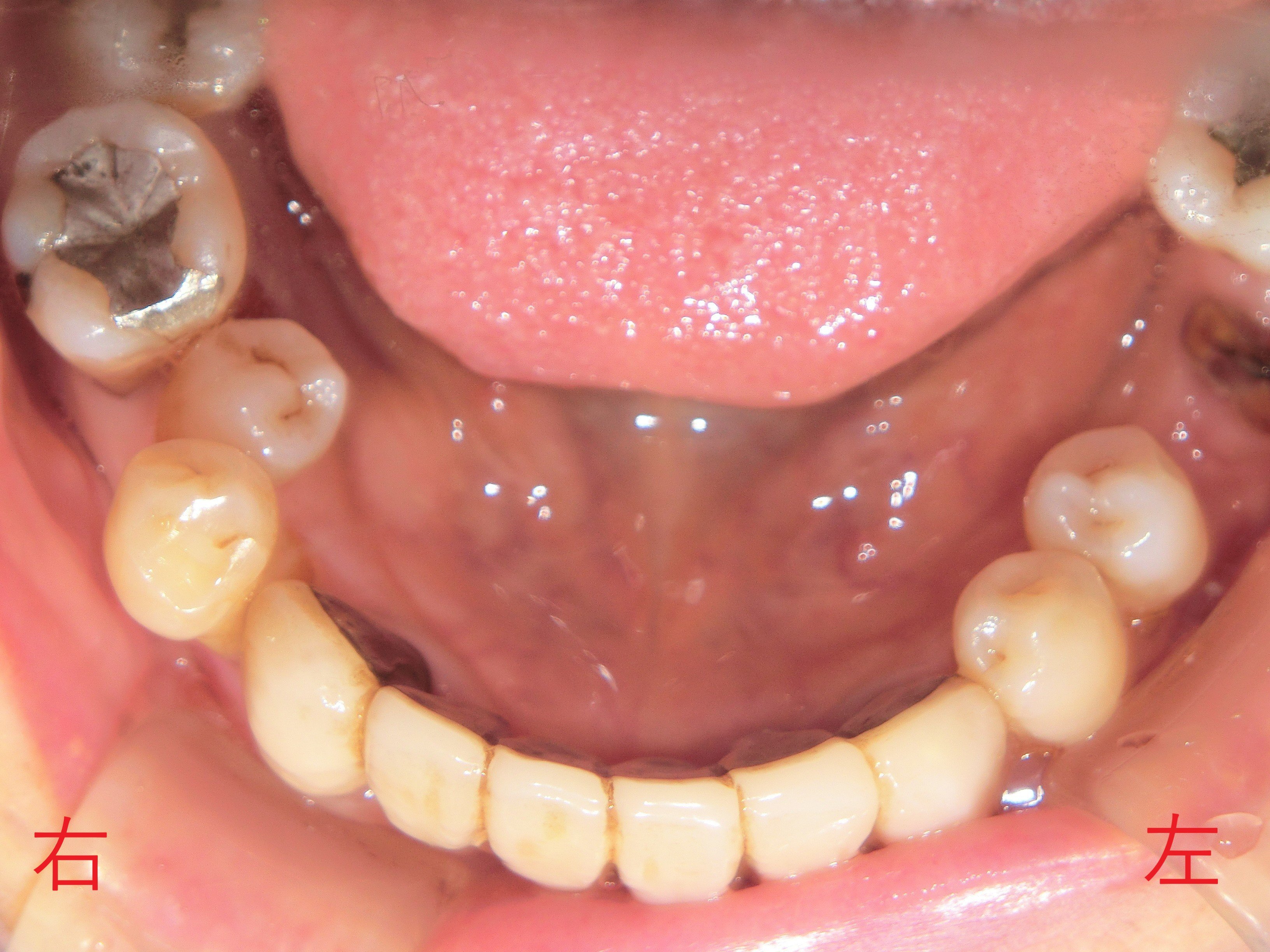 術後レントゲン