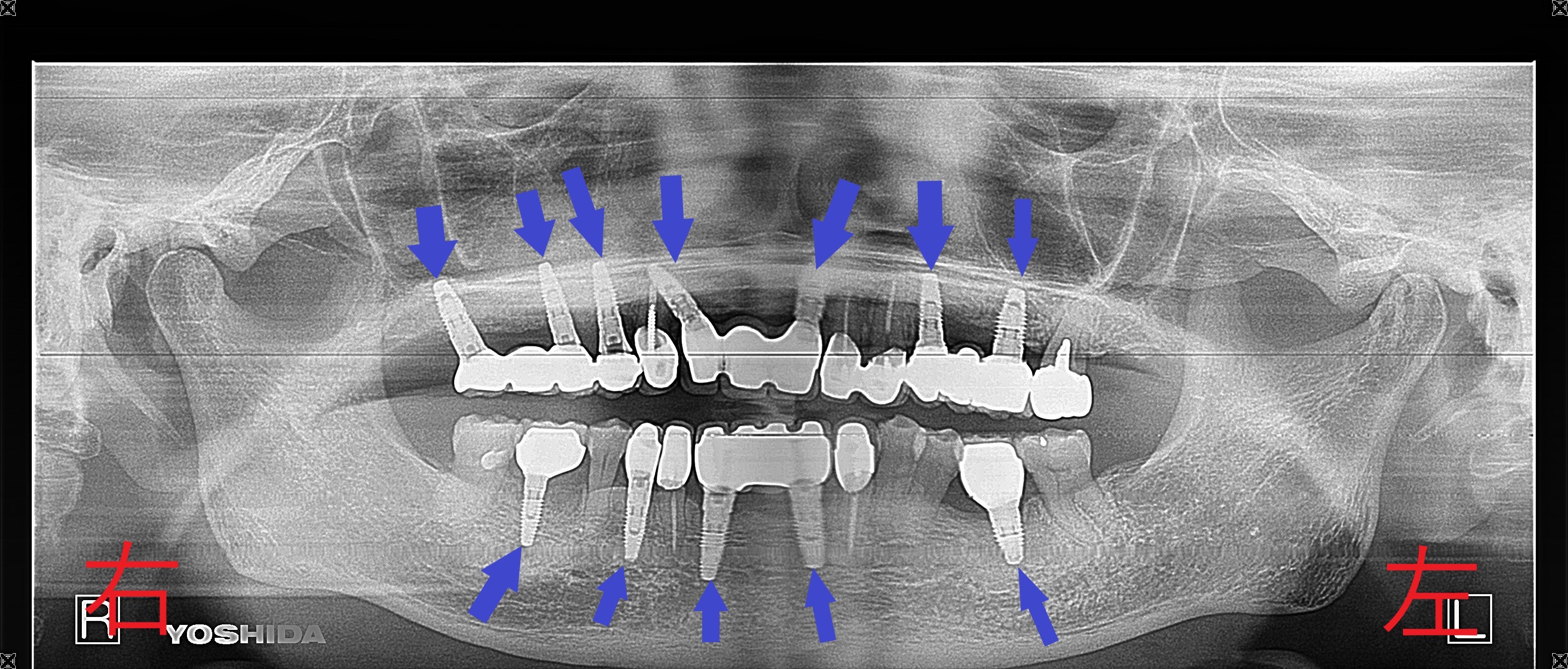 術前レントゲン