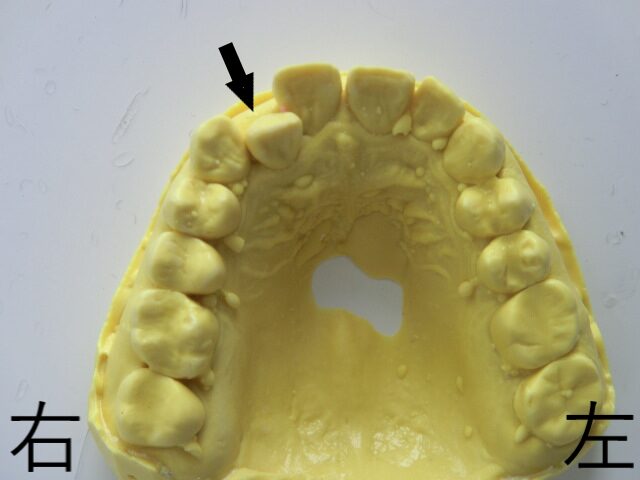 術前レントゲン