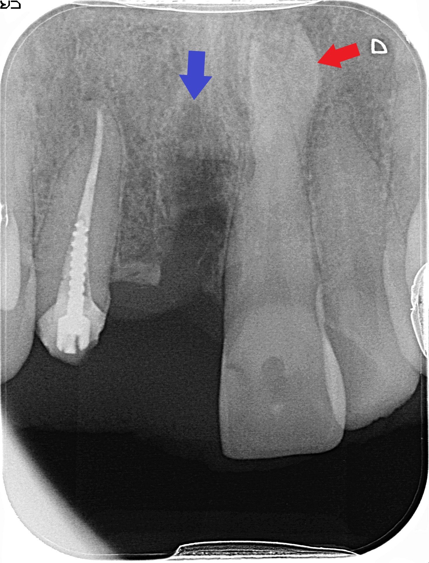 術前レントゲン