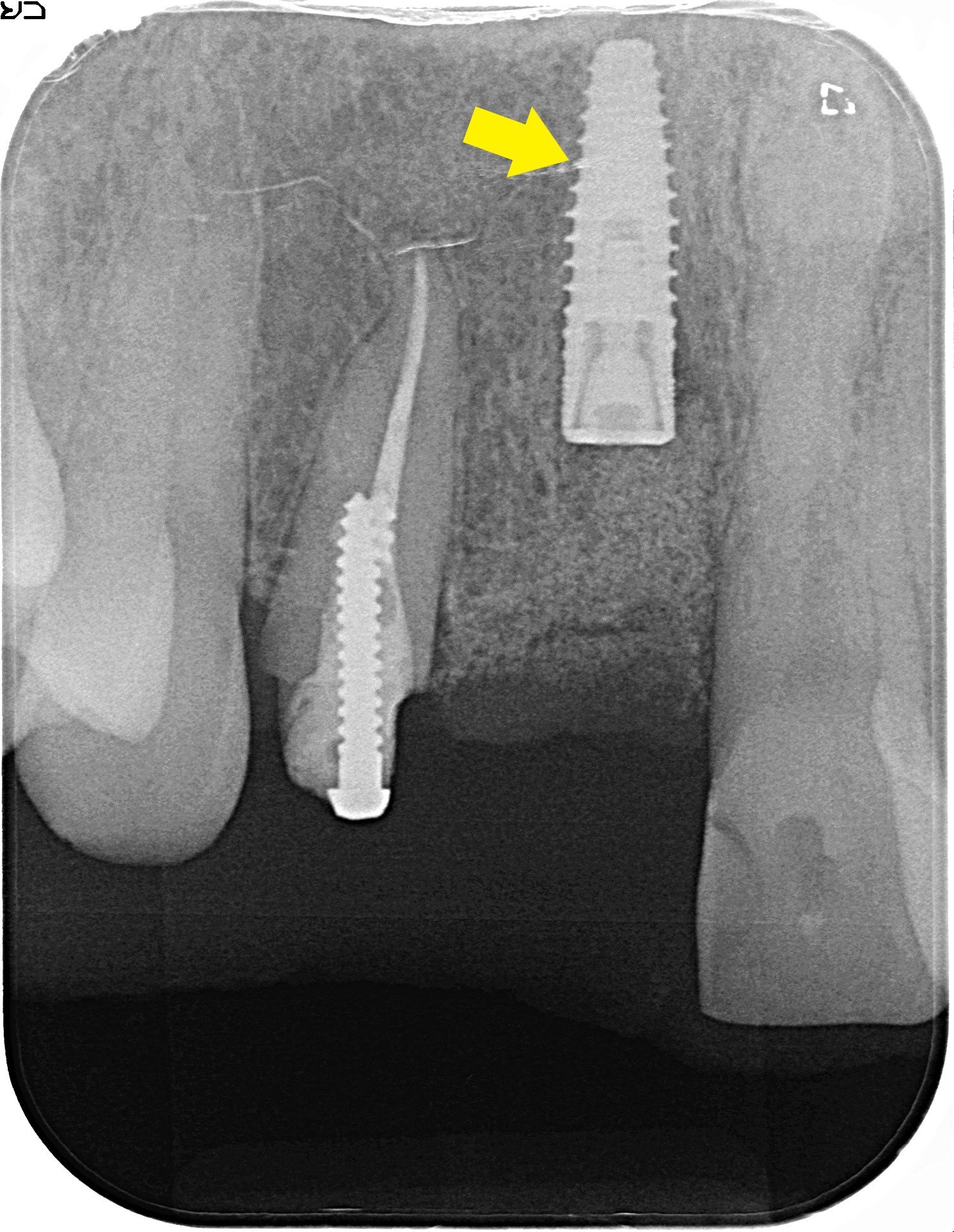 術後レントゲン