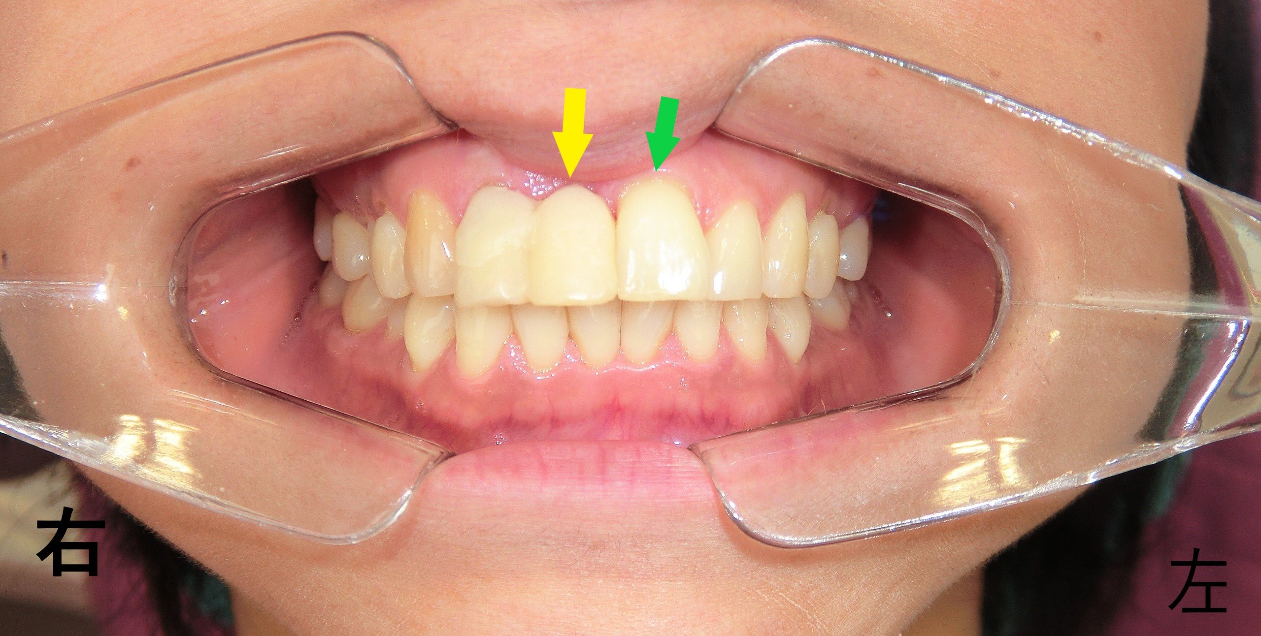 術前レントゲン