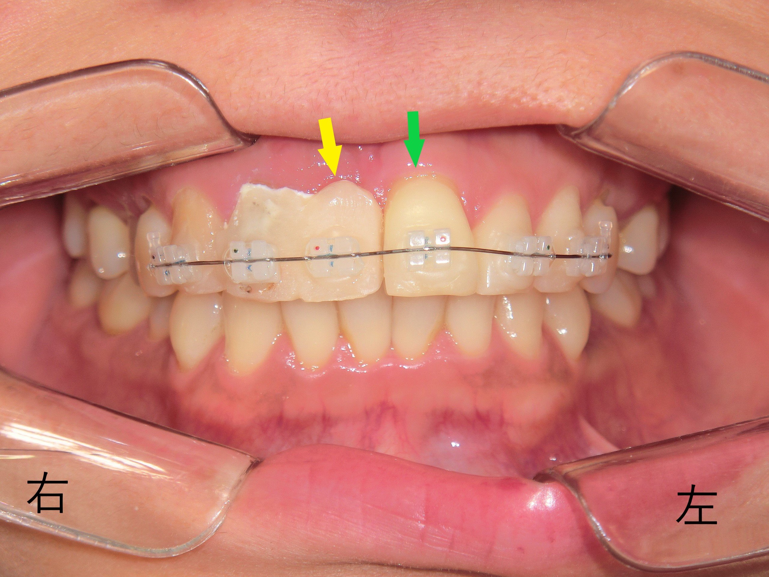 術前レントゲン