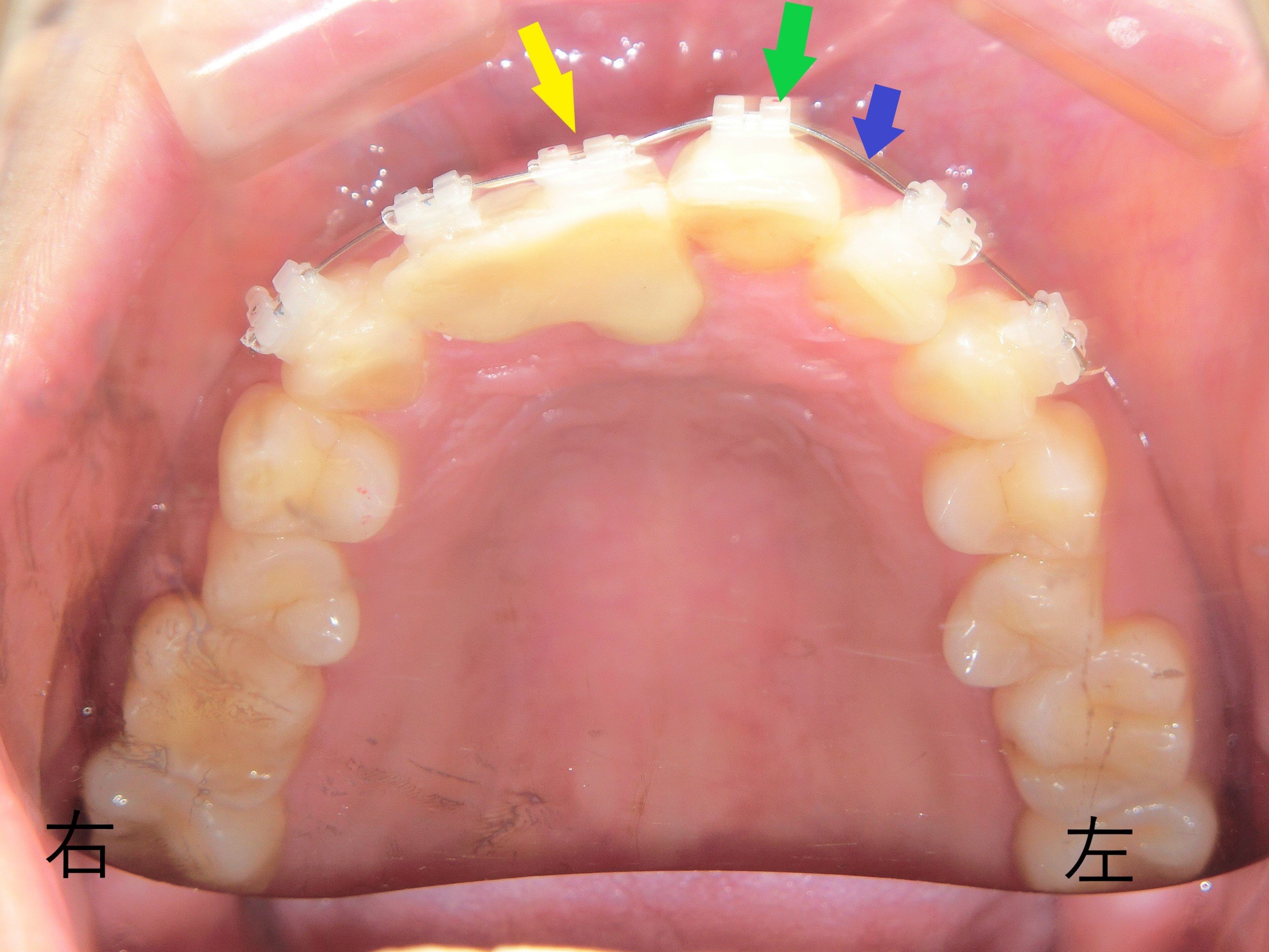 術後レントゲン